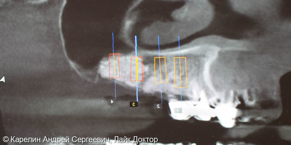 Тотальная реконструкция верхней и частичная нижней челюстей с помощью имплантатов и коронок на основе диоксида циркония - фото №17