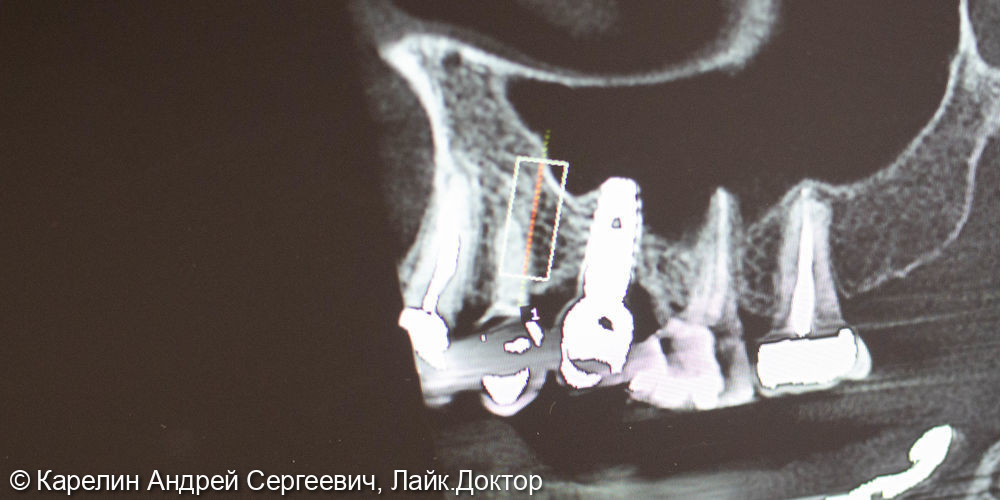 Тотальная реконструкция верхней и частичная нижней челюстей с помощью имплантатов и коронок на основе диоксида циркония - фото №22