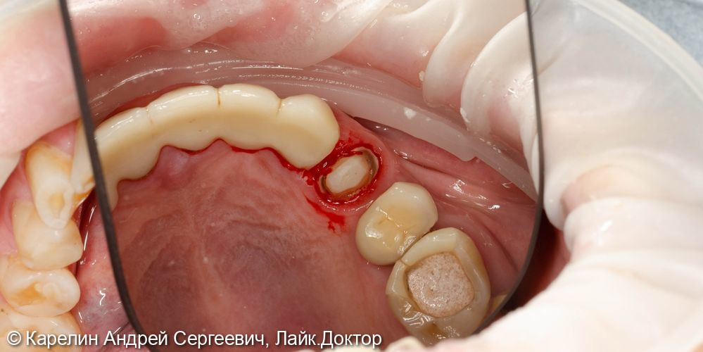 Тотальная реконструкция верхней и частичная нижней челюстей с помощью имплантатов и коронок на основе диоксида циркония - фото №23