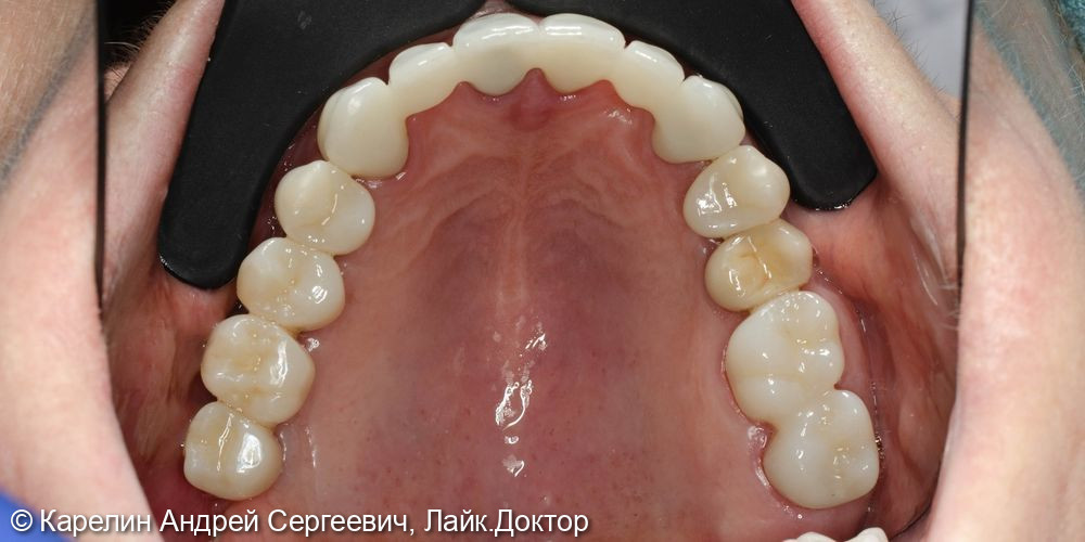 Тотальная реконструкция верхней и частичная нижней челюстей с помощью имплантатов и коронок на основе диоксида циркония - фото №30