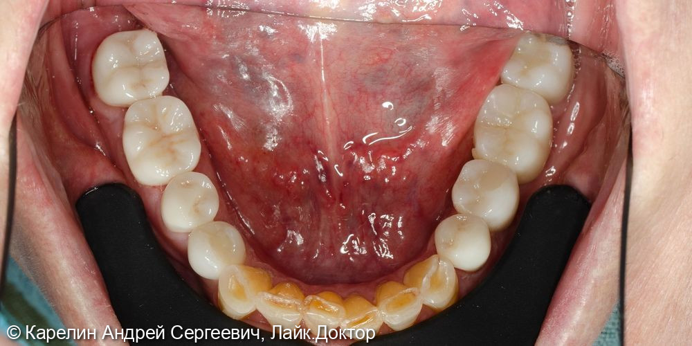 Тотальная реконструкция верхней и частичная нижней челюстей с помощью имплантатов и коронок на основе диоксида циркония - фото №31