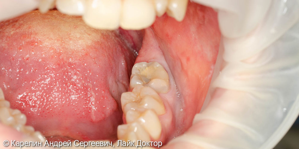 Удаление 3.7 зуба с кистой и ретинированного зуба 3.8 - фото №1