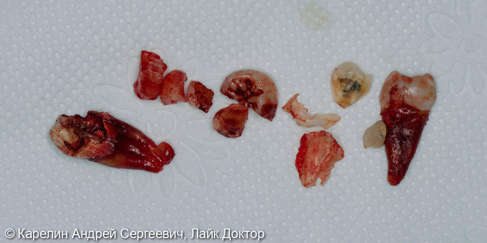 Удаление 3.7 зуба с кистой и ретинированного зуба 3.8 - фото №4