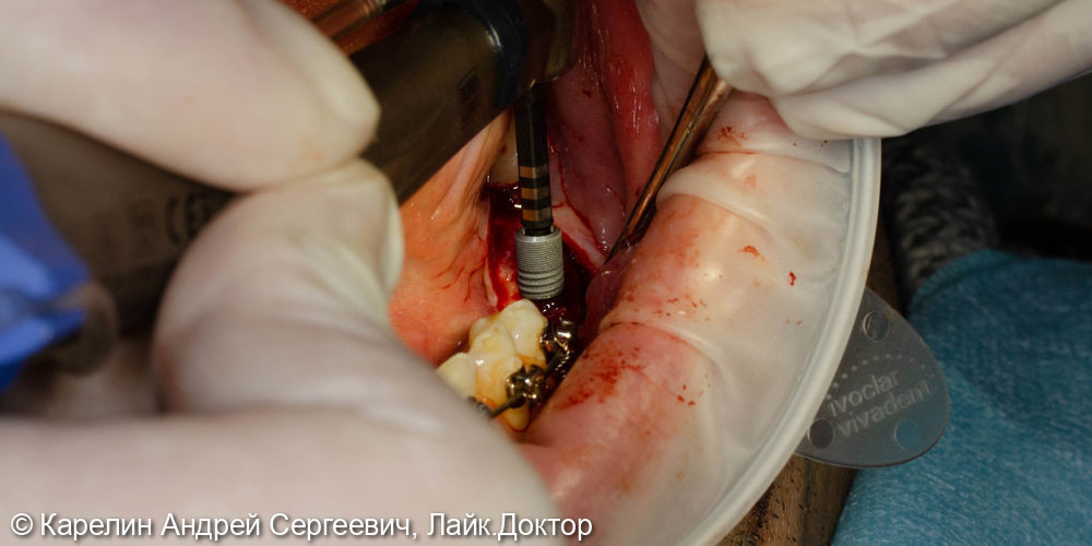 Тотальная реконструкция прикуса с помощью брекет систем, имплантатов и протезирования - фото №22