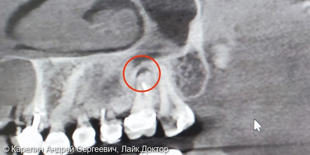 Перелечивание зуба 2.6 с диагнозом гранулирующий периодонтит - фото №1