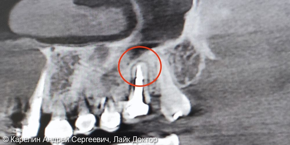 Перелечивание зуба 2.6 с диагнозом гранулирующий периодонтит - фото №2