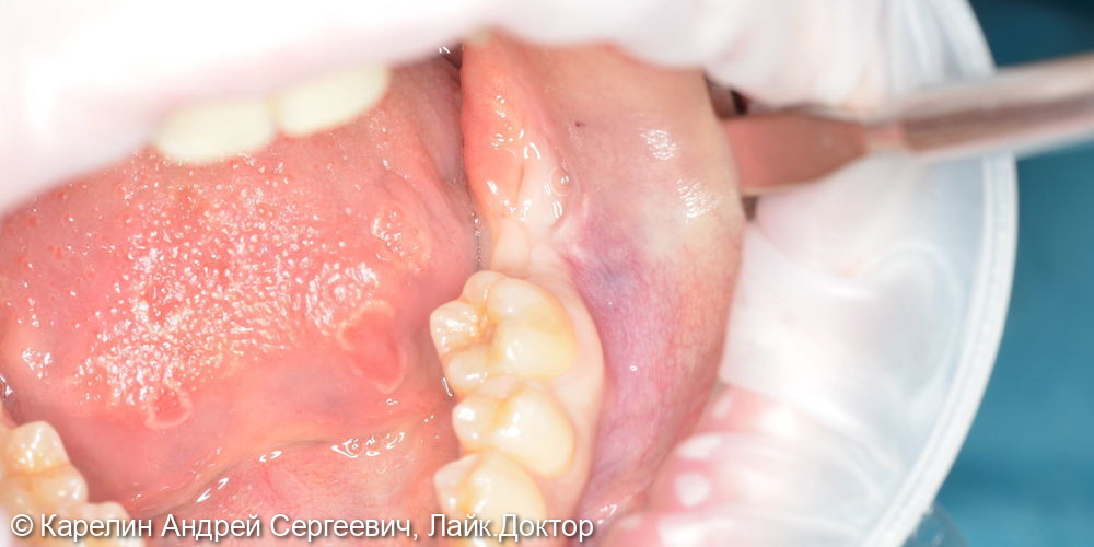 Удаление 3.7 зуба с кистой и ретинированного зуба 3.8 - фото №6