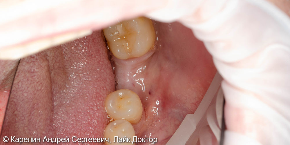 Костная пластика, пластика слизистой, имплантатция и протезирование жевательных участков нижней челюсти - фото №2