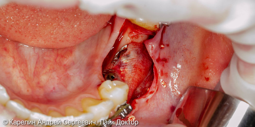Костная пластика, пластика слизистой, имплантатция и протезирование жевательных участков нижней челюсти - фото №4