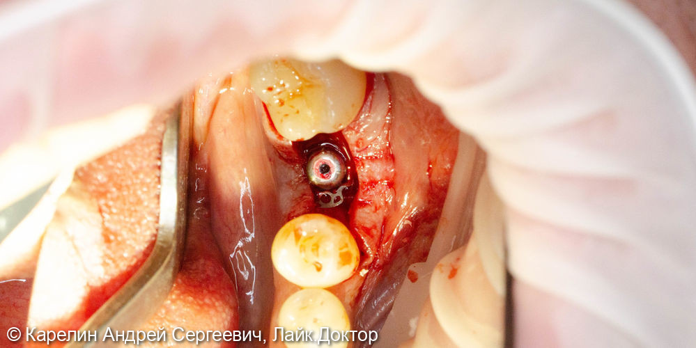 Костная пластика, пластика слизистой, имплантатция и протезирование жевательных участков нижней челюсти - фото №5