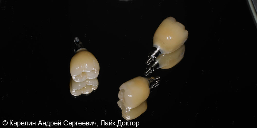Костная пластика, пластика слизистой, имплантатция и протезирование жевательных участков нижней челюсти - фото №13