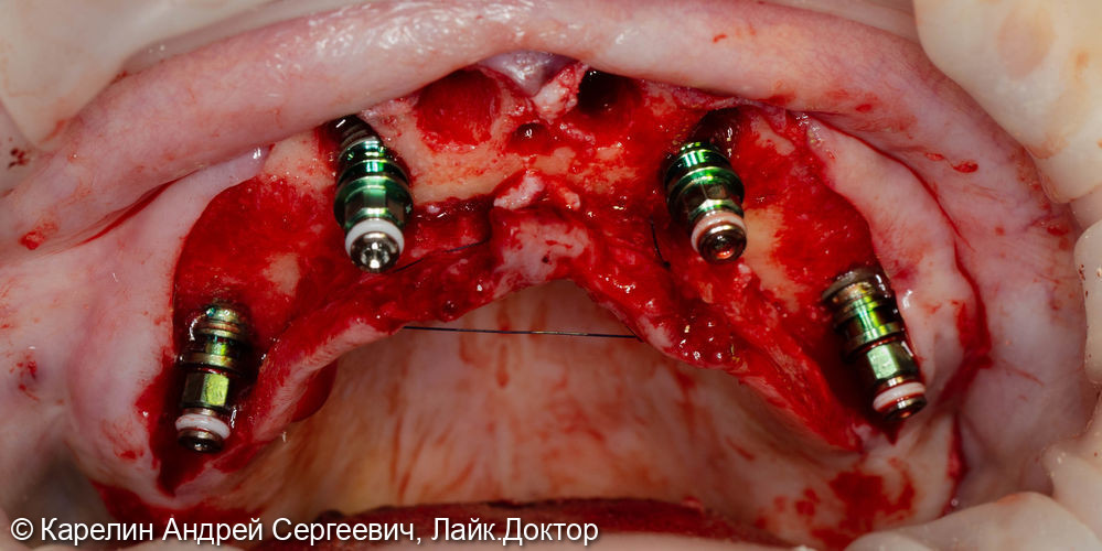 Тотальная реконструкция зубочелюстной системы с помощью имплантатов и 2 бюгелей с балочной фиксацией на имплантаты - фото №6