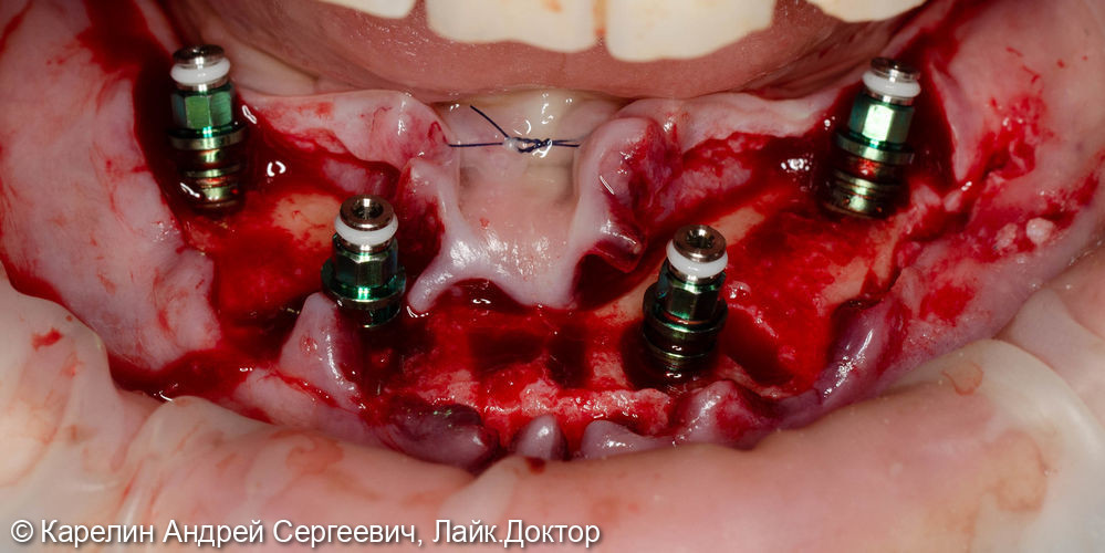 Тотальная реконструкция зубочелюстной системы с помощью имплантатов и 2 бюгелей с балочной фиксацией на имплантаты - фото №9