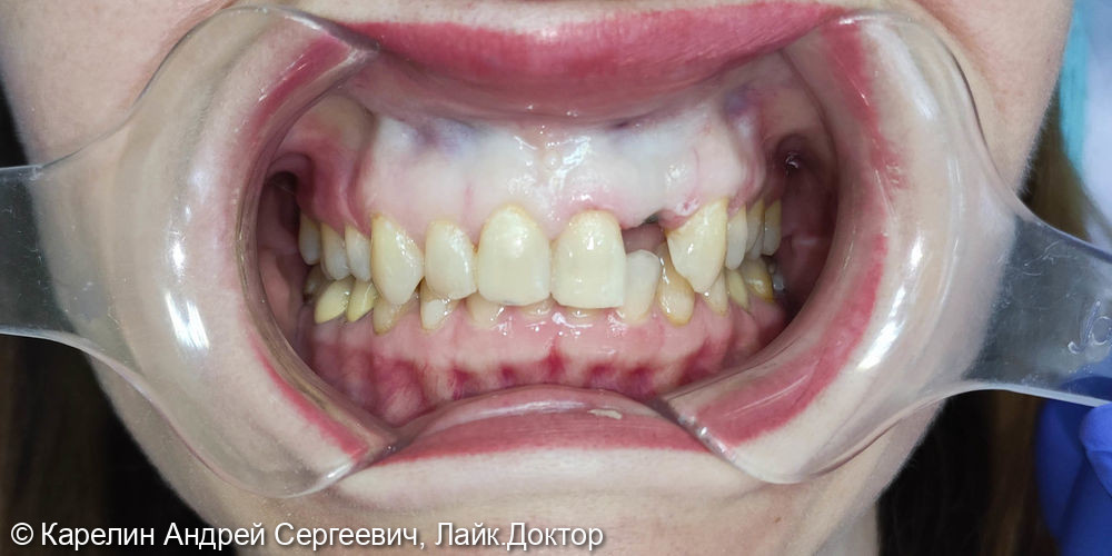 Протезирование фронтального участка верхней челюсти с помощью виниров и имплантата - фото №2