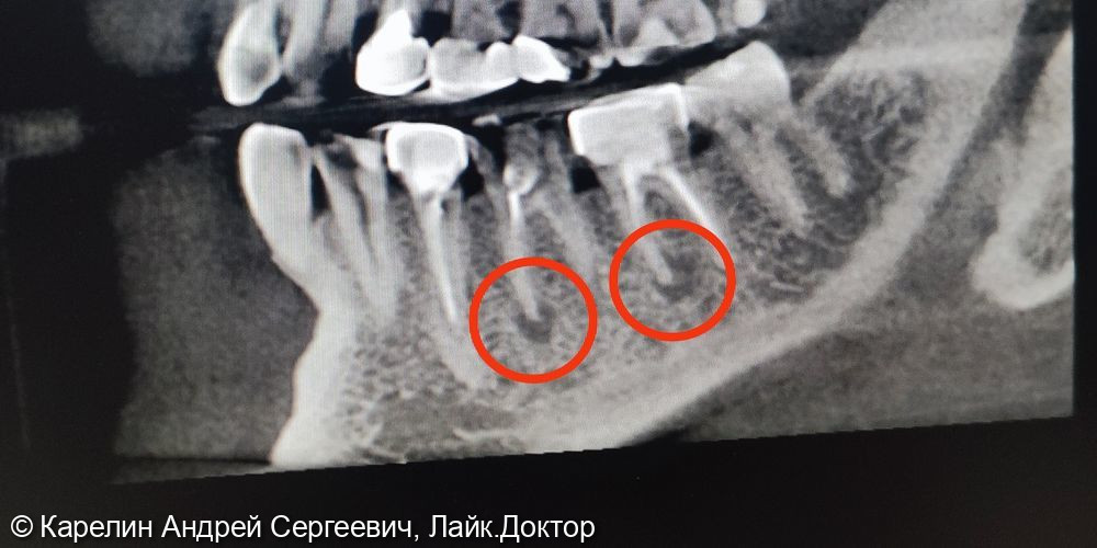 Лечение периодонтита зубов 3.6 и 3.7 - фото №1