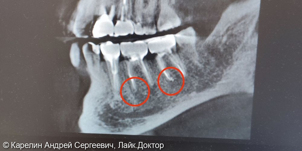 Лечение периодонтита зубов 3.6 и 3.7 - фото №2