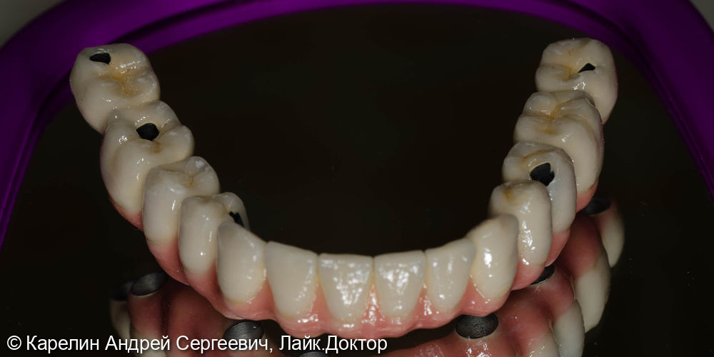 Тотальная реабилитация обеих челюстей с помощью имплантатов и коронок - фото №5