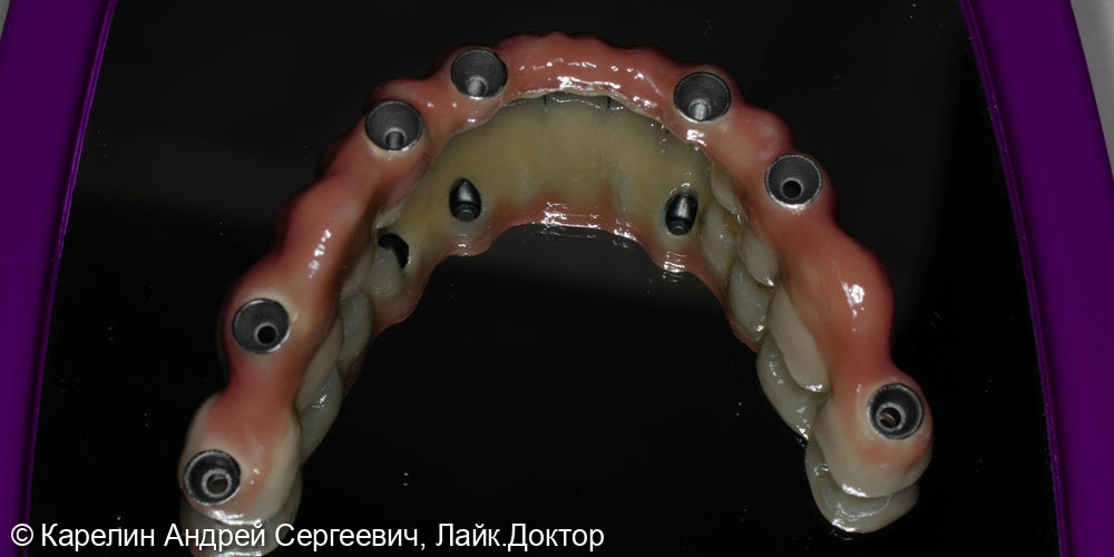 Тотальная реабилитация обеих челюстей с помощью имплантатов и коронок - фото №6