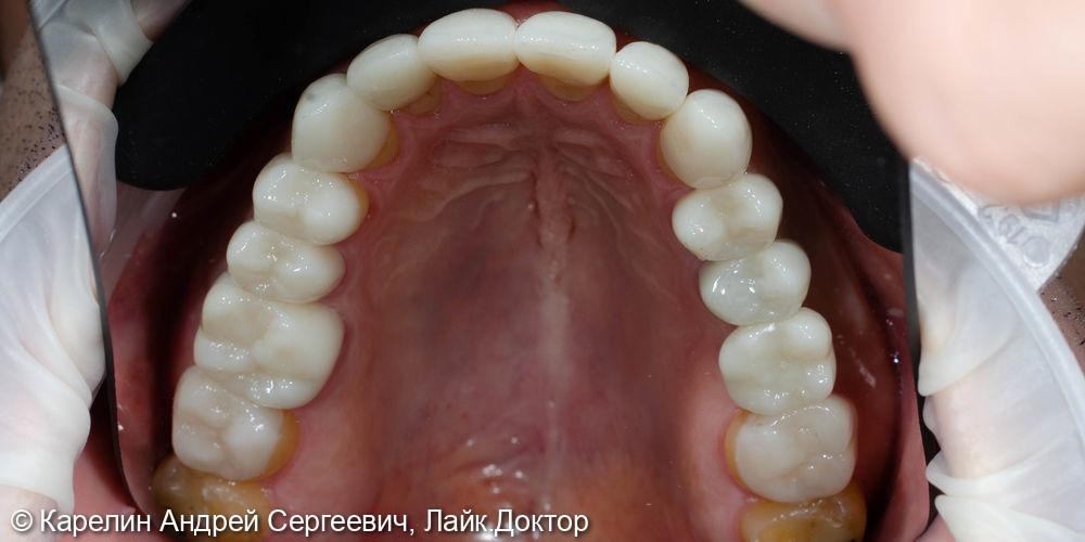 Тотальное протезирование после лечения брекетами фото 4 · Воронеж