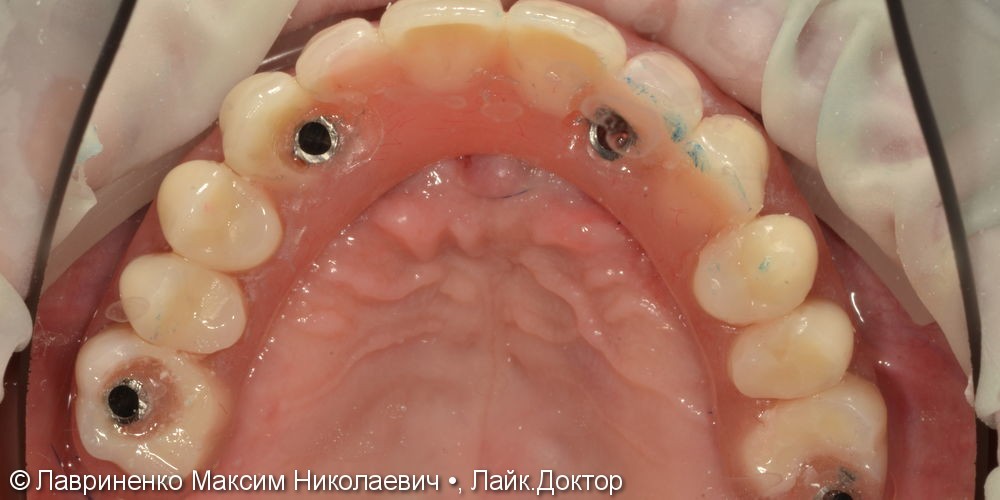Комплексная реабилитация по технологии ALL-ON-4 на верхнюю челюсть и изготовление 12 коронок на нижнюю челюсть - фото №3