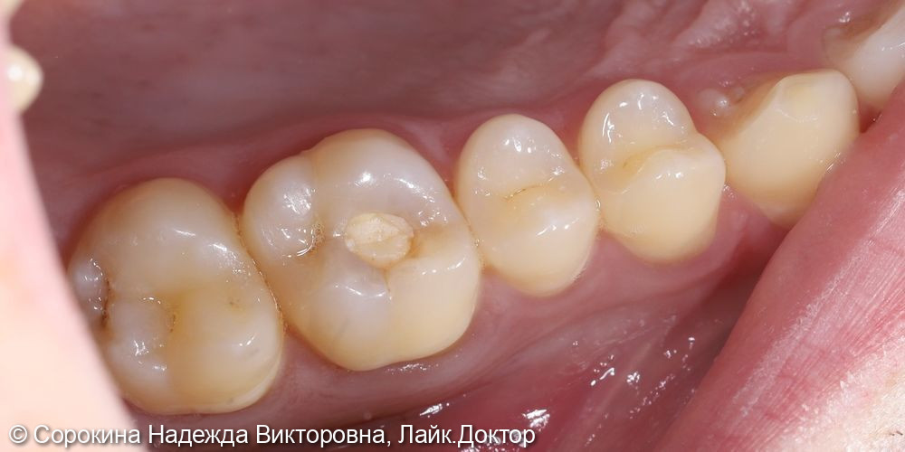 Лечение кариеса зуба 1.6 - фото №1