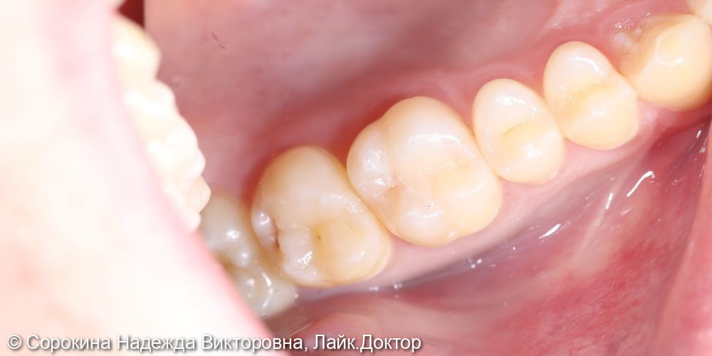 Лечение кариеса зуба 1.6 - фото №2