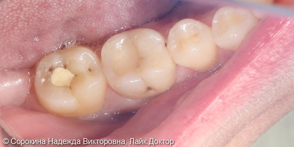 Лечение кариеса 36 и 37 зуба - фото №1
