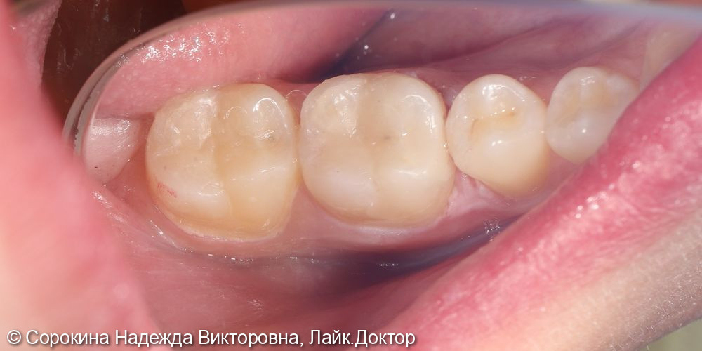 Лечение кариеса 36 и 37 зуба - фото №2