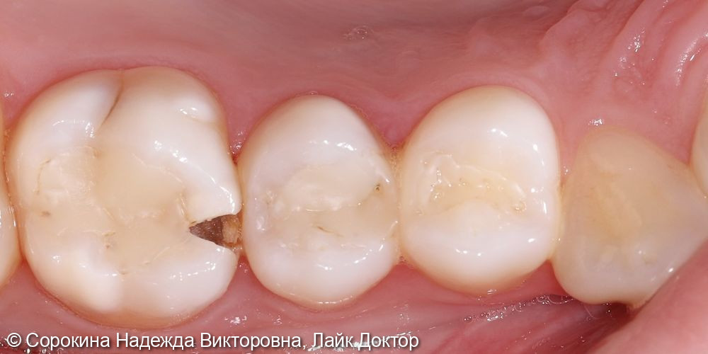 Лечение кариеса 1.6 - фото №2
