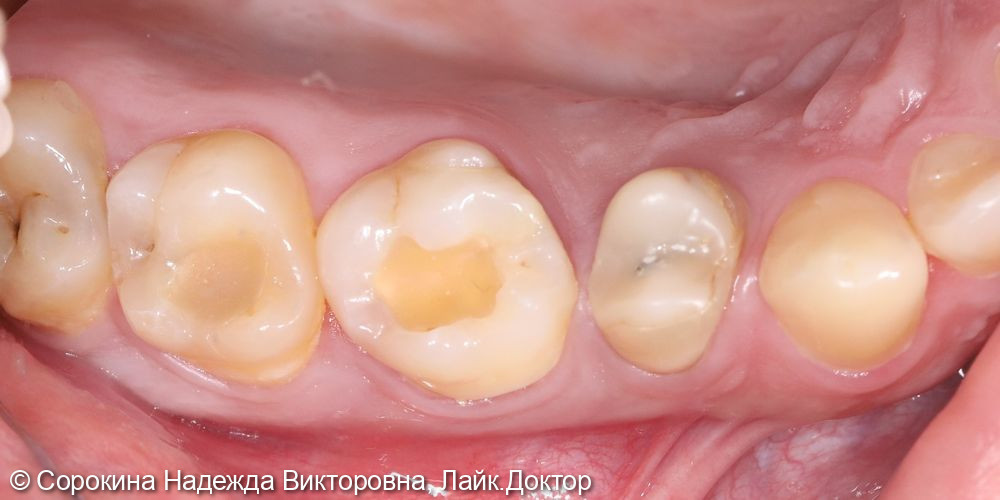 Лечение кариеса 1.6, 1.7 - фото №1