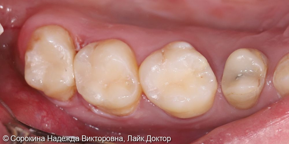 Лечение кариеса 1.6, 1.7 - фото №2