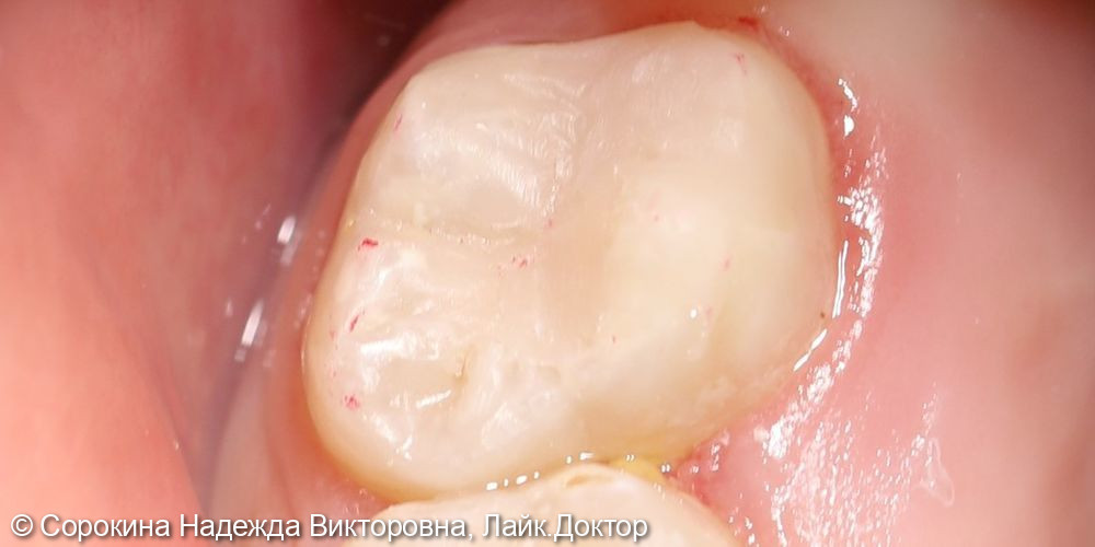 Лечение кариеса 1.6 и 1.7 - фото №2