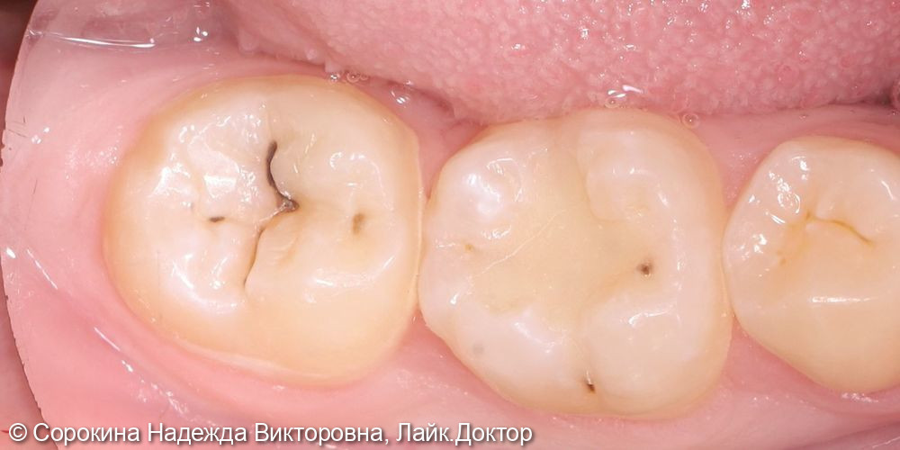 Лечение кариеса 36 и 37 зубов - фото №1