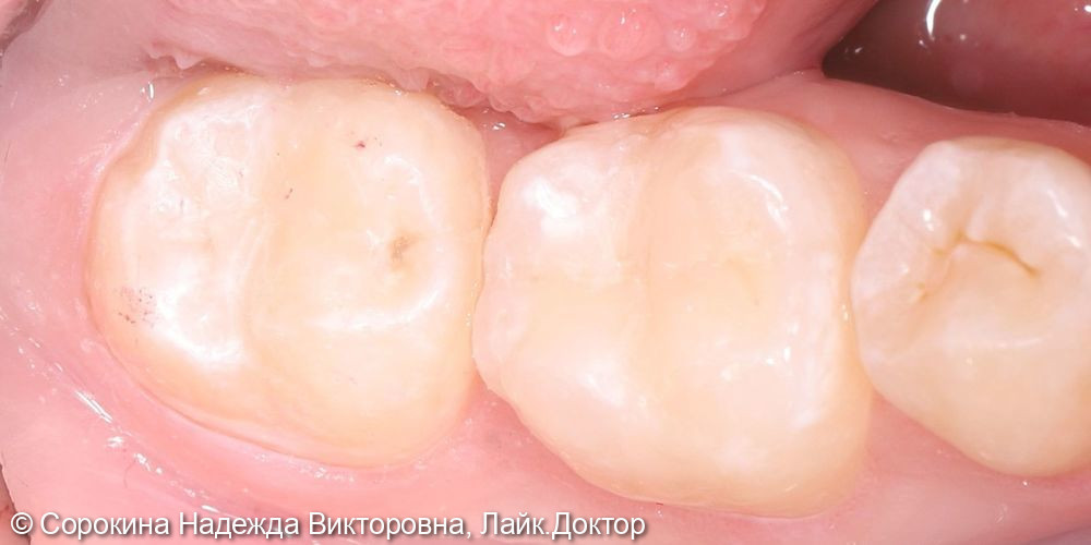 Лечение кариеса 36 и 37 зубов - фото №2