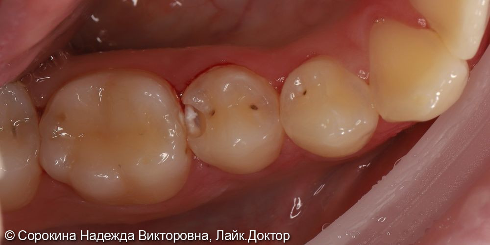 Лечение кариеса фото 2 · Вологда