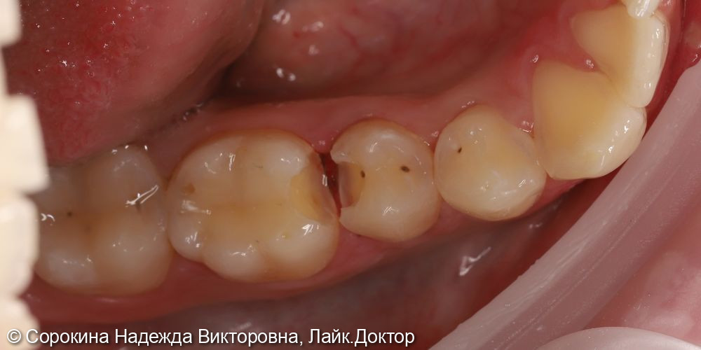 Лечение кариеса фото 3 · Вологда