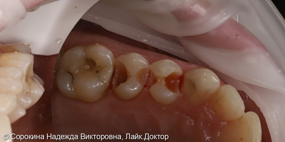 Лечение глубокого кариеса зубов 2.4 и 2.5 - после