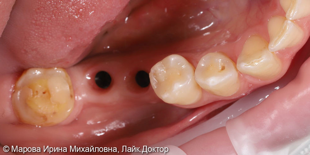 Установить имплантаты в область утраченных зубов: 3.6, 3.7 - фото №1