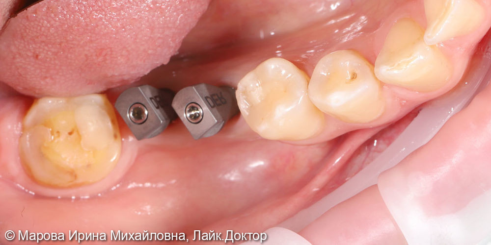 Установить имплантаты в область утраченных зубов: 3.6, 3.7 - фото №2