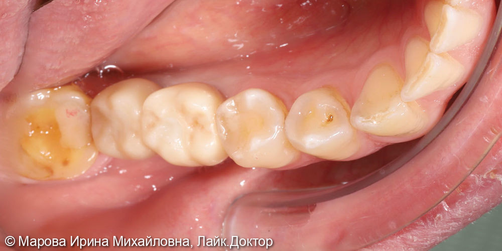 Установить имплантаты в область утраченных зубов: 3.6, 3.7 - фото №3