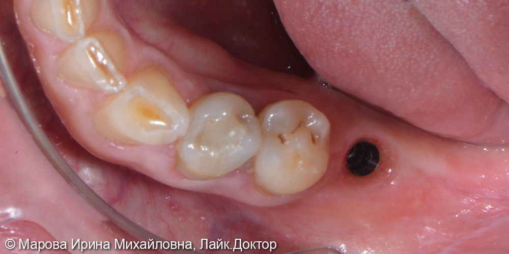 Установить имплантат в область утраченного зуба 3.6 - фото №1