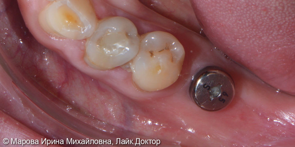 Установить имплантат в область утраченного зуба 3.6 - фото №2