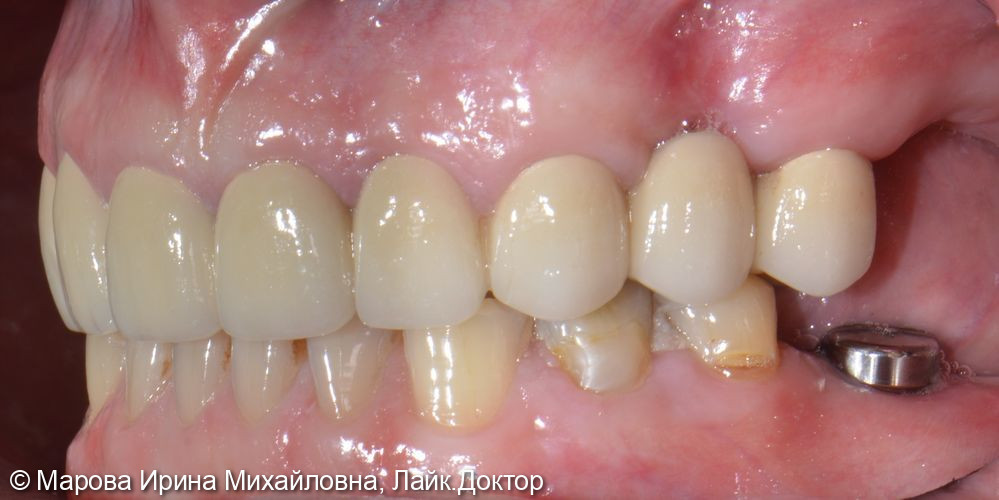 Установить имплантат в область утраченного зуба 3.6 - фото №3