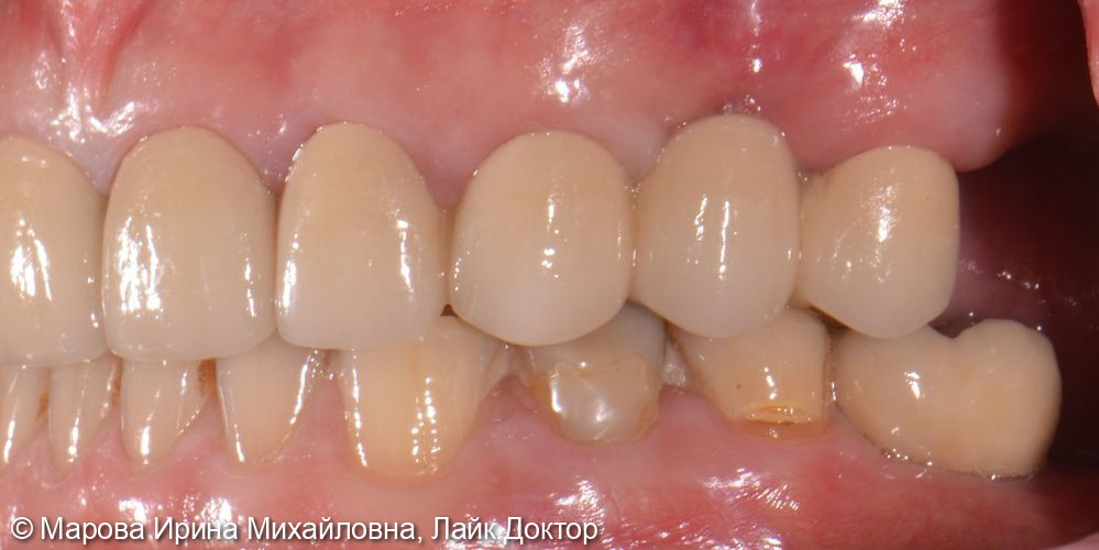 Установить имплантат в область утраченного зуба 3.6 - фото №5