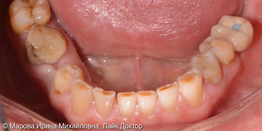 Установить имплантат в область утраченного зуба 3.6 - фото №6