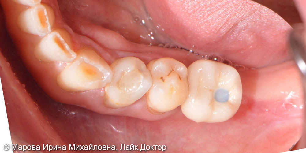 Установить имплантат в область утраченного зуба 3.6 - фото №7