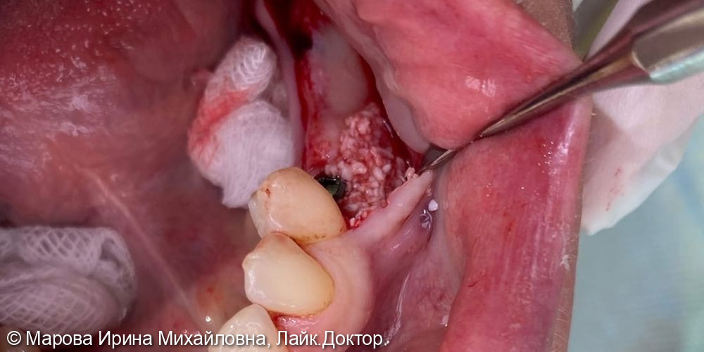 имплантация, в области нижней челюсти слева, нкр - фото №3