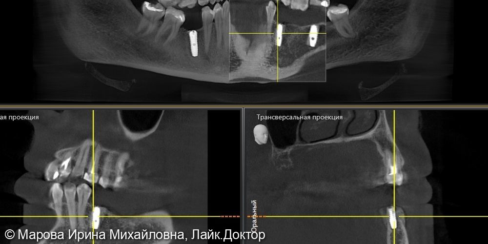 имплантация, в области нижней челюсти слева, нкр - фото №6
