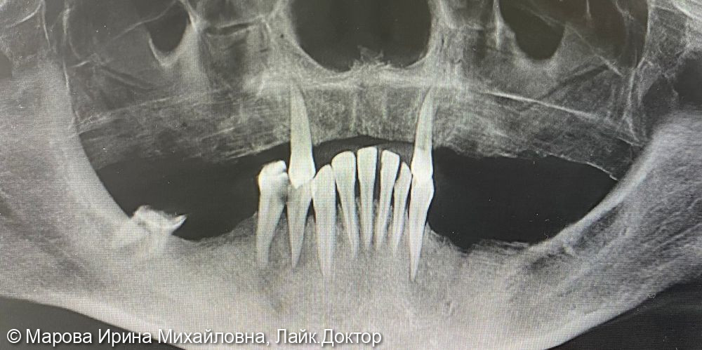 имплантация в области верхней челюсти - фото №6