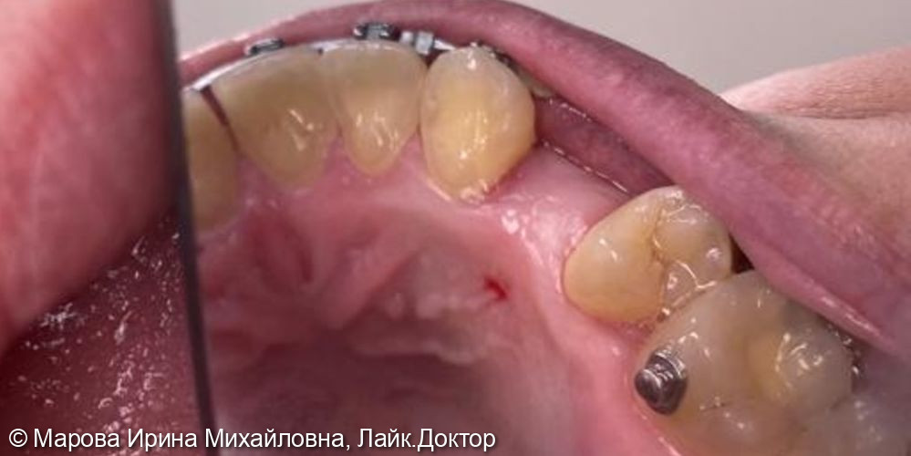 Имплантация в проекции зуба 1.4 - фото №1